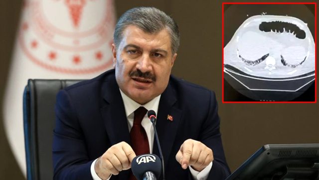 Bakan Koca, Bu kez dikkat çeken görüntüyle uyardı: Covid-19 zor bir hastalıktır